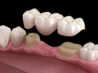 Dental Bridges