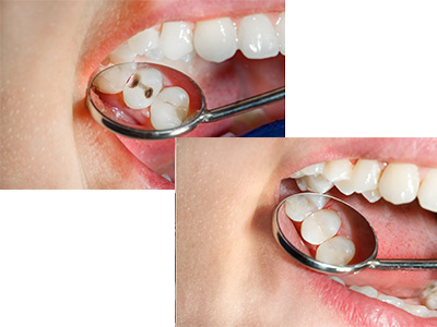 Dental Fillings