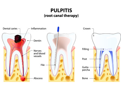 Root Canals